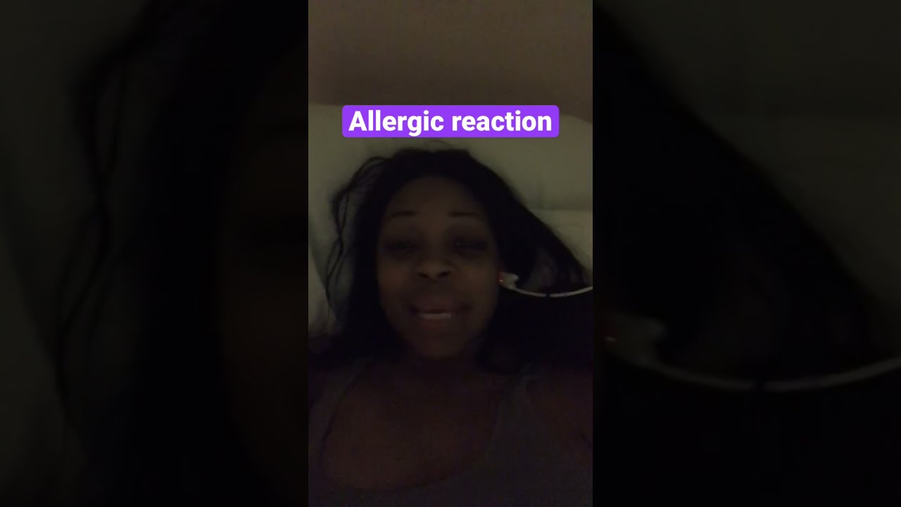 Allergic Reaction Angioedema Swollen Lip to Lisinopril blood Pressure Allergic Reaction Angioedema Swollen Lip to Lisinopril blood Pressure