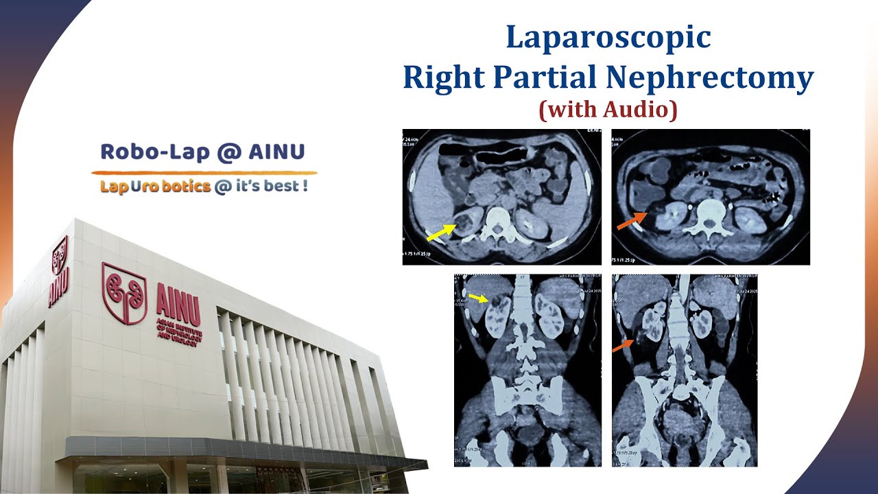 Laparoscopic Right Partial Nephrectomy with Audio | RoboLap@AINU 2025 ...