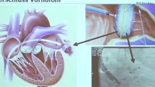 Herzrhythmusstörungen - Vorhofflimmern - Dr. Wirth - SLK