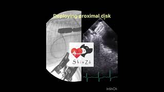 Deploying Amplatzer vascular plug II to occlude patent ductus arteriosus in a dog.