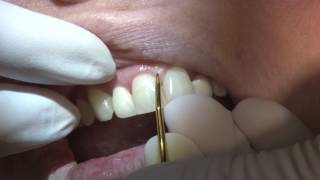 Double Gracey Anterior Curette By American Eagle Instruments