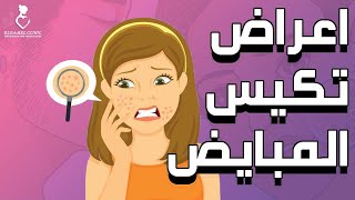 أعراض تكيس المبايض | الحلقة الثانية