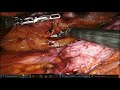 Robotic incisional hernia mesh repair