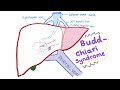 Budd-Chiari syndrome (Def., causes, pathophysiology, Dx& ttt)