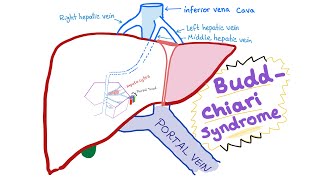 BuddChiari syndrome  Definition, Causes, Pathophysiology, Diagnosis & Treatment  Hepatology