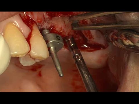 Sinus lifting using Osteotome on post  maxilla