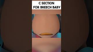 C section for Breech Baby | Dr Rhythm Gupta - IVF Specialist in Delhi