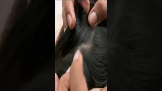تنظيف الشعر من الحشرات 😰القمل