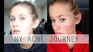 STRUGGLING WITH ACNE AND BLUSHING (Tips & Tricks)