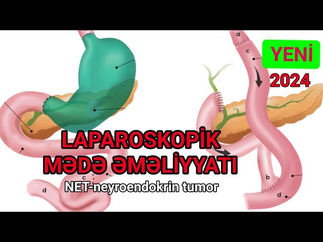 Mədə neyroendokrin tumoru və maligin xorası,laparoskopik qastrektomiya,D2