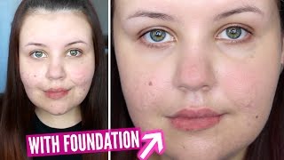 First Impressions | Make Up For Ever Water Blend Foundation (Acne Scarring)