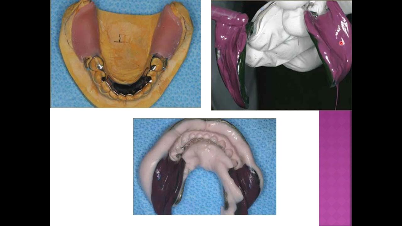 IMPRESSION TECHNIQUES IN REMOVABLE PARTIAL DENTURES YouTube