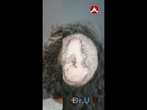 Folliculitis Decalvans Surgical Excision Before and After | Dr. Sanusi Umar