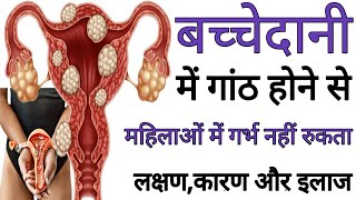 बच्चेदानी में गांठ या रसौली होने का कारण, लक्षण, इलाज, उपचार,  - Fibroid ka ilaj in hindi