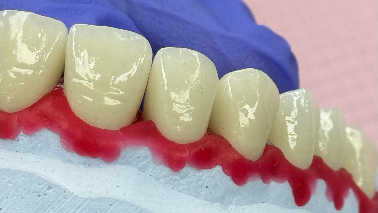 Serkoniy dioksid tishlari haqida qisqacha , bez metal keramika, metalsiz keramik tish