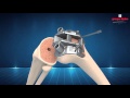 New wave surgical technique 3d animation