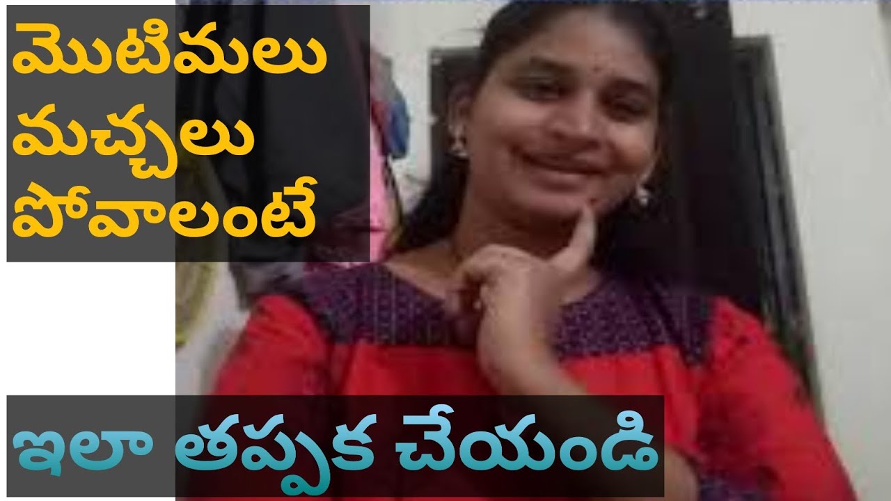 మొటిమలు మచ్చలు పోవాలంటే|motimalu machalu povalante emi cheyali|Telugu Vlogs Kusuma Vasavi |Health