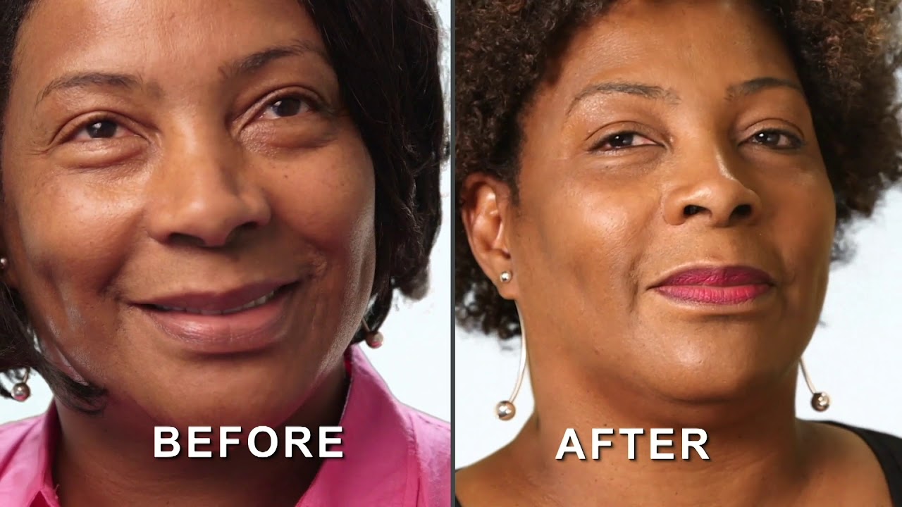 Eye Lift Lexington Plastic Surgeons YouTube