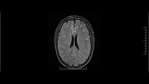 MRI showing progressive multifocal leukoencephalopathy