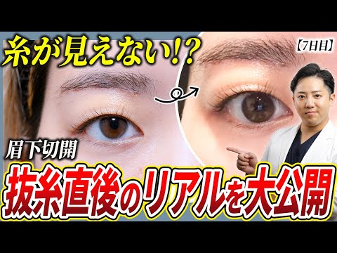 【20代後半眉下切開】“抜糸直後”がヤバい…！痛み・赤み・傷跡のリアルを大公開！14日間ダウンタイム記録付！