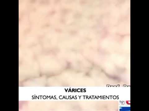 video ca vene varicoase trateaza lipitori tablete de la varicoz phlebodia
