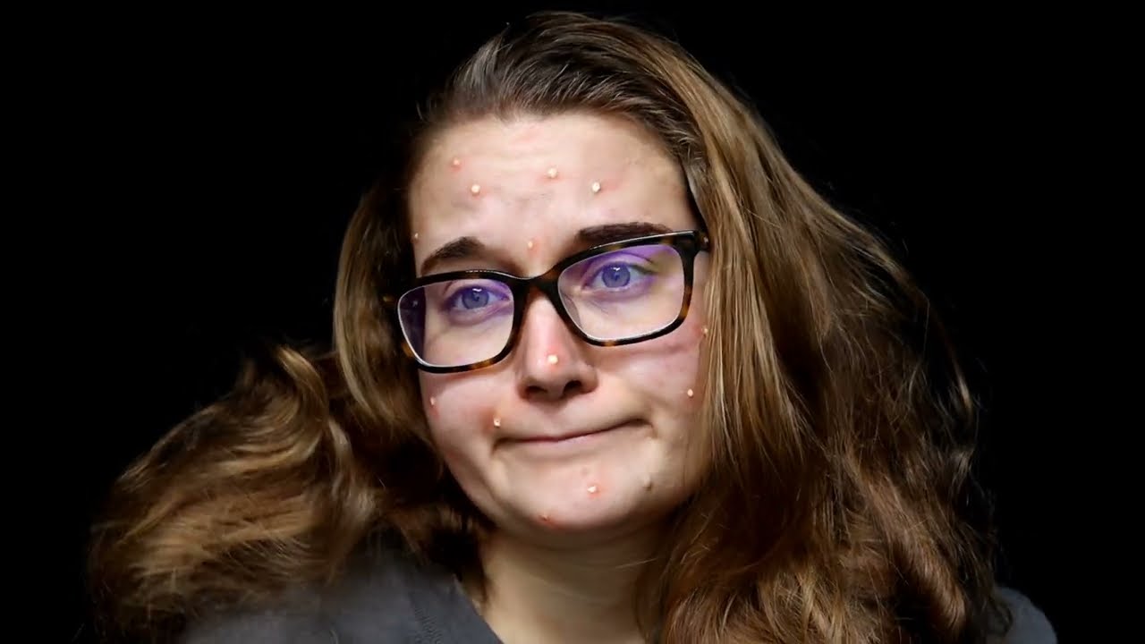 Fake Acne SFX Makeup Tutorial 26|31 Days of Halloween Makeup 💄