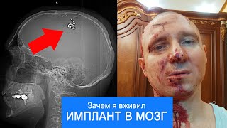 Сделал себе трепанацию? История от первого лица