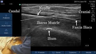 Us-Guided Fascia Iliaca Block Full Video Link Below