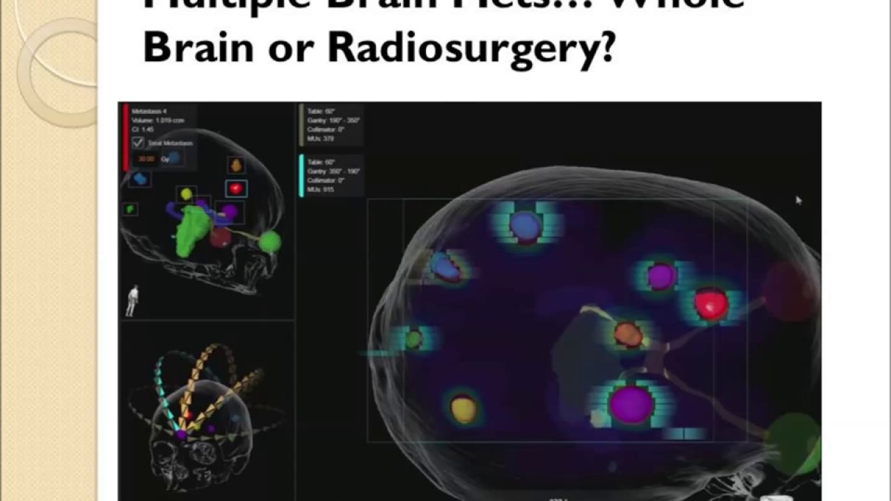 Radiation Therapy for Melanoma - YouTube