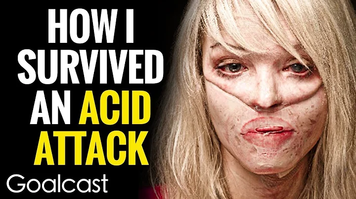 My Facebook Stalker Threw Acid In My Face | Katie ...