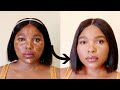 COVER HYPERPIGMENTATION AND MELASMA WITHOUT FOUNDATION|LOREAL INFALLIBLE MORE THAN CONCEALER