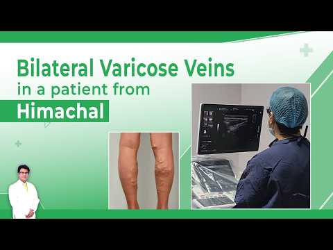 Varicose Veins With MOCA Ablation.