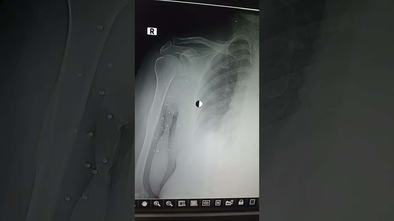 shoulder X ray ap view 