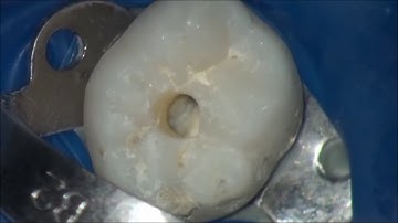 Mở tủy răng hàm