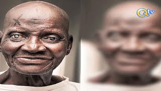 Viuno Vya Mtoto Wa Chuo Mtoto Wa Jicho Cataract Ni Nini Cute766