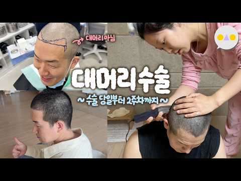 {두두로그} 40살 두근두근 첫 성형^^* ~비절개 완전삭발 2000모 <strong>모발이식</strong>~
