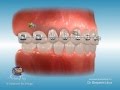 Orthodontic Marketing & Patient Education: Temporary Anchorage Devices (TADs)