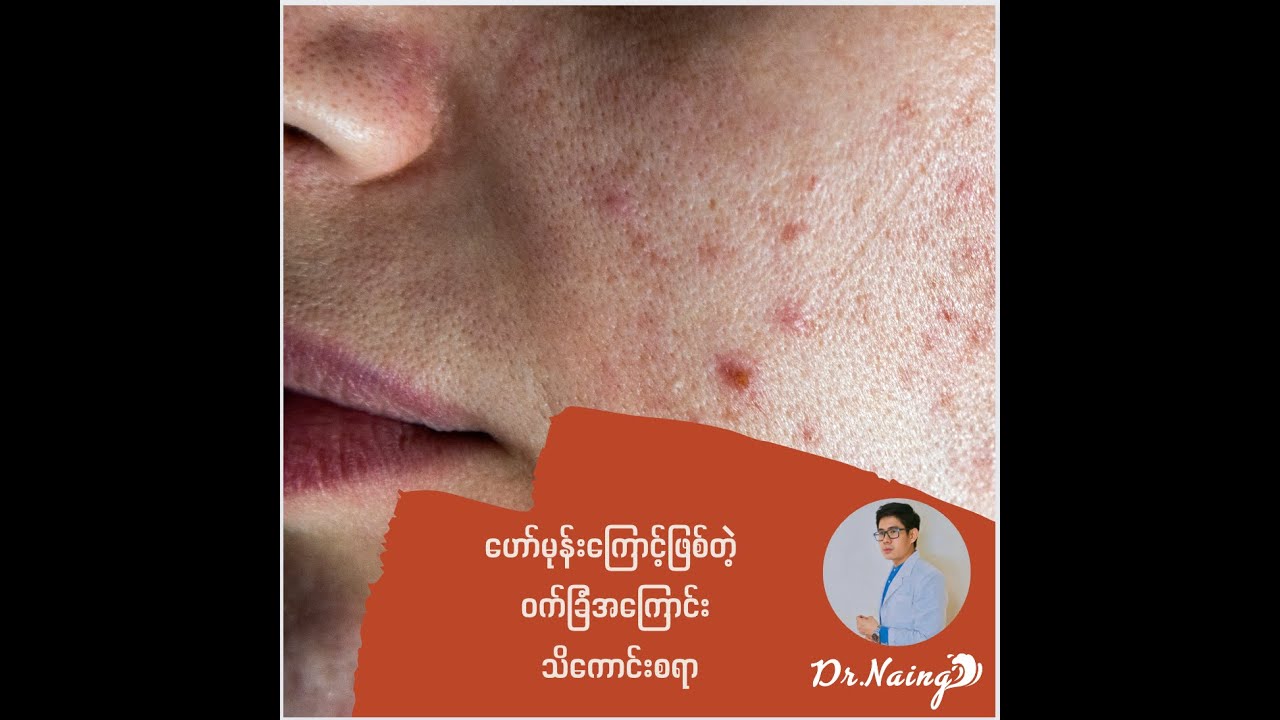 Hormonal Acne - ဟော်မုန်းကြောင့်ဖြစ်သော ဝက်ခြံအကြောင်းသိကောင်းစရာ
