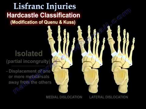 Lisfranc Injuries - YouTube