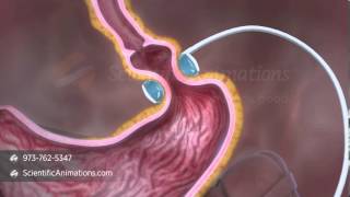 Gastric Band Digestive System Animation