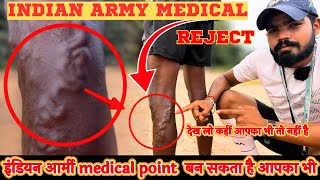 इंडियन आर्मी मेडिकल point बन सकता है आपका भी देख लो नहीं तो रिजेक्ट / Indian army Varicose problem 😭