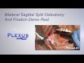 Bilateral Sagittal Split Osteotomy