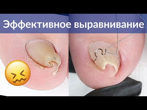 Как выровнять скрученный ноготь на ногах | Скоба на вросший ноготь | Педикюр