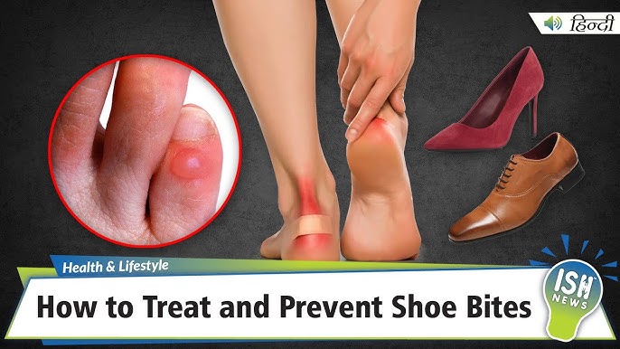 Prevent And Treat Painful Shoe Bites 2024