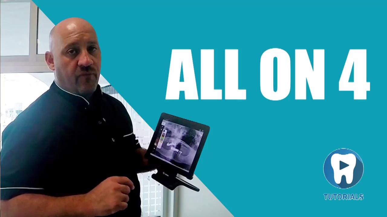 Doctor German Arzate Tutorials: All-on-4 dental implant results