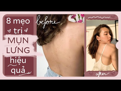 Sữa Tắm Trị Mụn Lưng Cho Nam - 8 MẸO TRỊ MỤN LƯNG HIỆU QUẢ TẠI NHÀ | PhuongHa