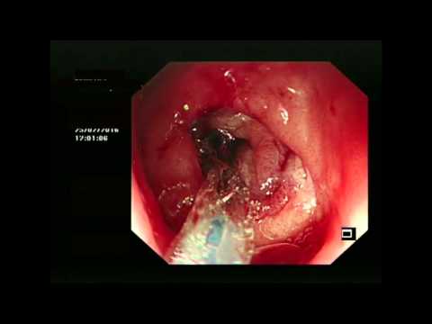 Pyloric stenosis - balloon dilatation