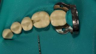 Matrix for Posterior Composite