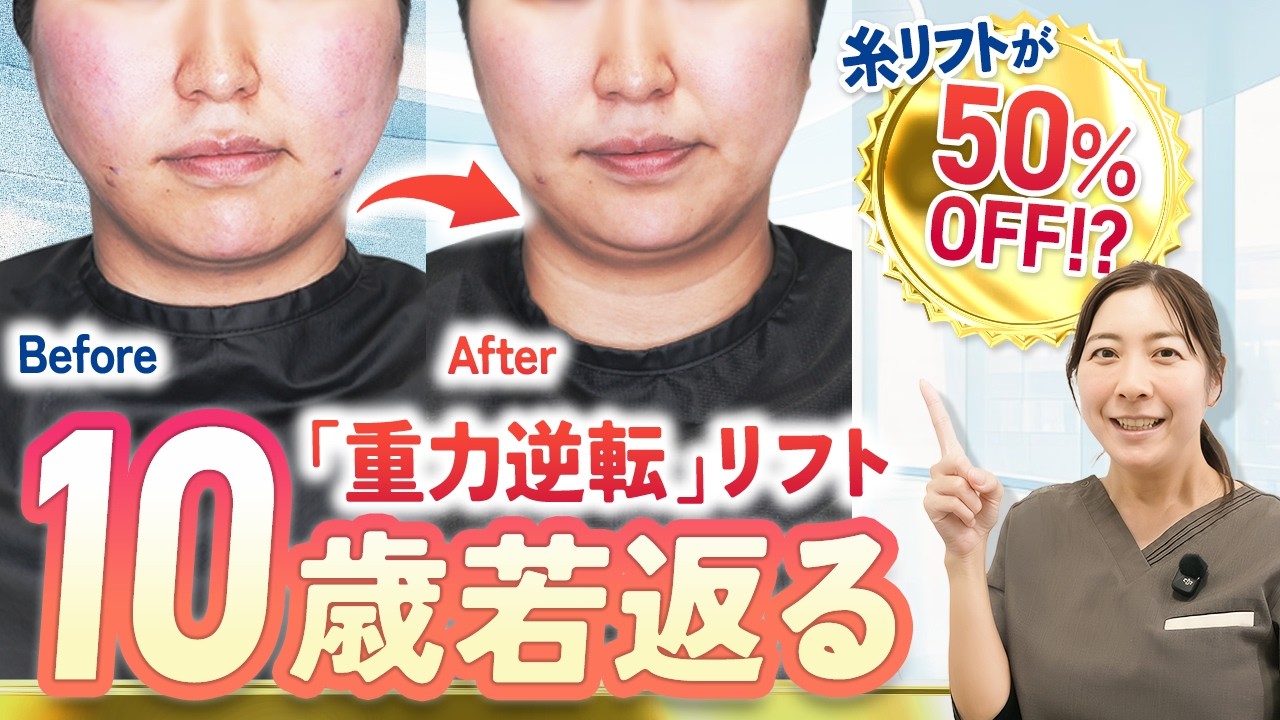Thread Lift Amazing Episode✨] Look 10 Years Younger!? Dr. Sakio's