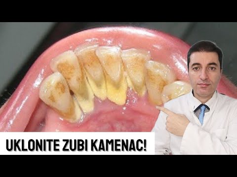 Video: Kako popraviti labav zub: 11 koraka (sa slikama)